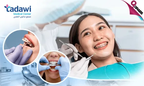 Dental Services: Metal Braces, Adjustment, Retainer & Consultation at Tadawi Medical Center!